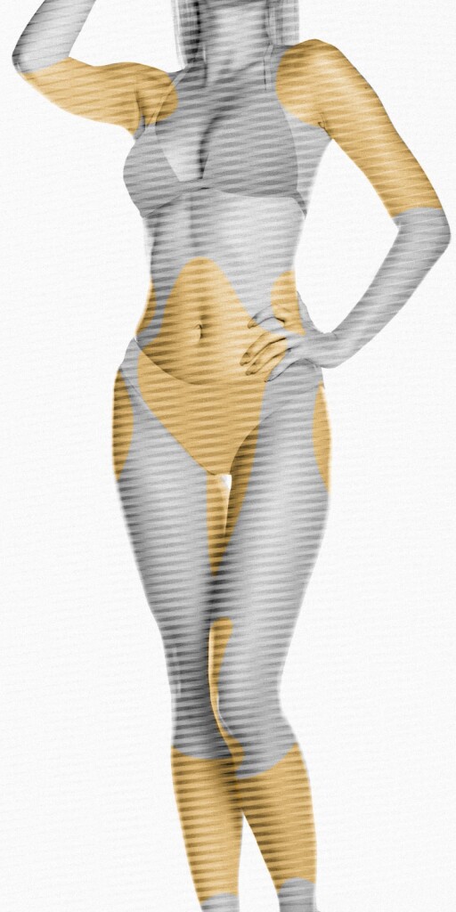Fettab­saugung (Lipo­suktion)